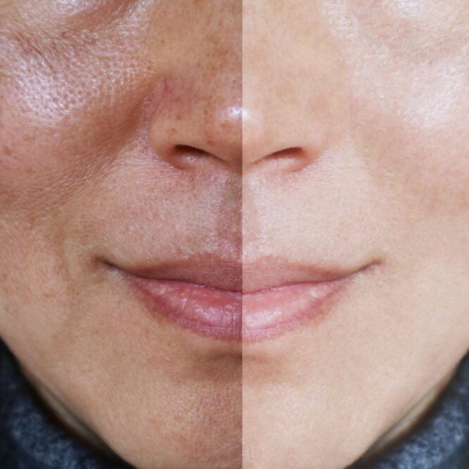 Ways to Even Skin Tone